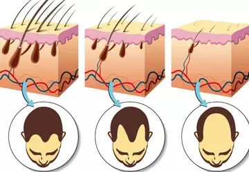 Mikro-Nadelpflaster bekämpft Kahlheit, indem es den ...