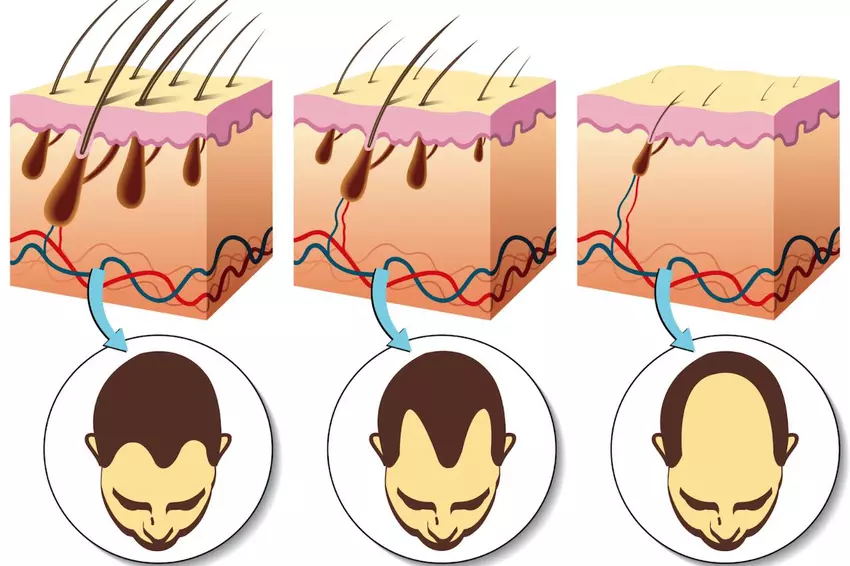 Mikro-Nadelpflaster bekämpft Kahlheit, indem es den Blutfluss zu den Follikeln erhöht