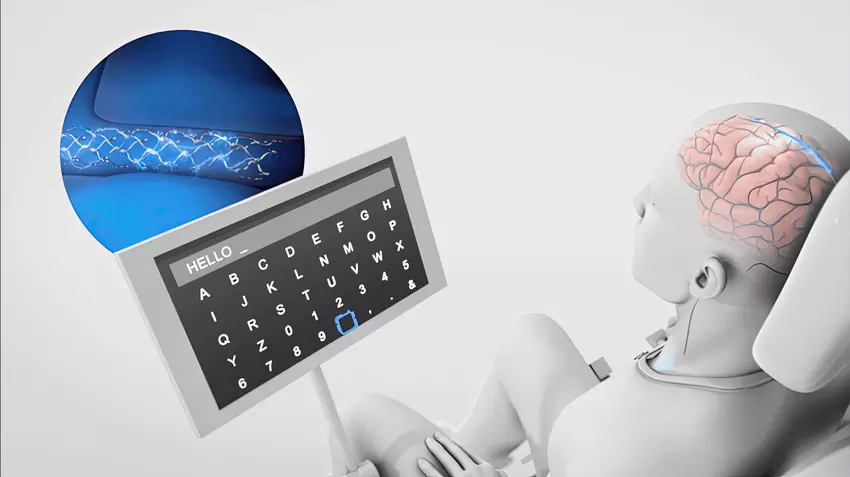 Synchron hat ChatGPT in seine Gehirnimplantate integriert