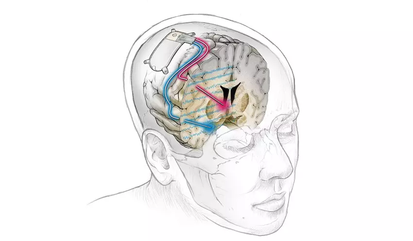 Weltweit erstes Hirnimplantat behandelt erfolgreich anhaltende Depression bei einem Patienten