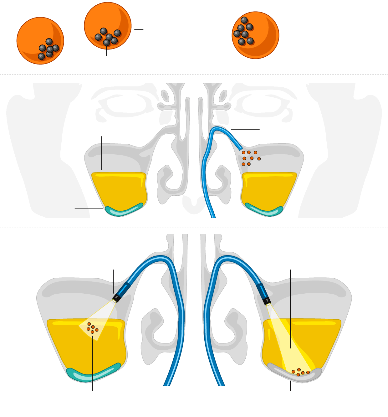 Wie Mikroroboter funktionieren (Maßstab nicht gezeigt). Illustration: Guardian Illustration von Mikrorobotern zur Behandlung von Sinusitis